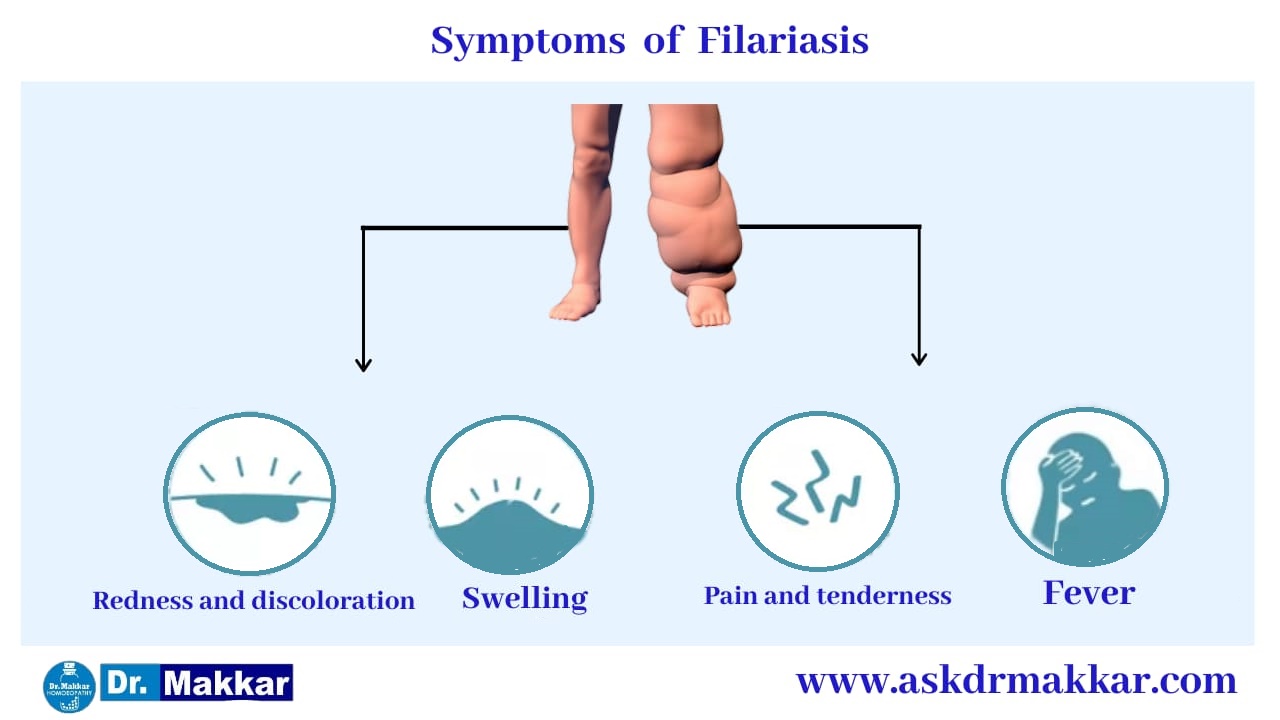 Symptoms of Lymphatic Filariasis ||  लसीका फाइलेरिया हाथी पांव के लक्षण