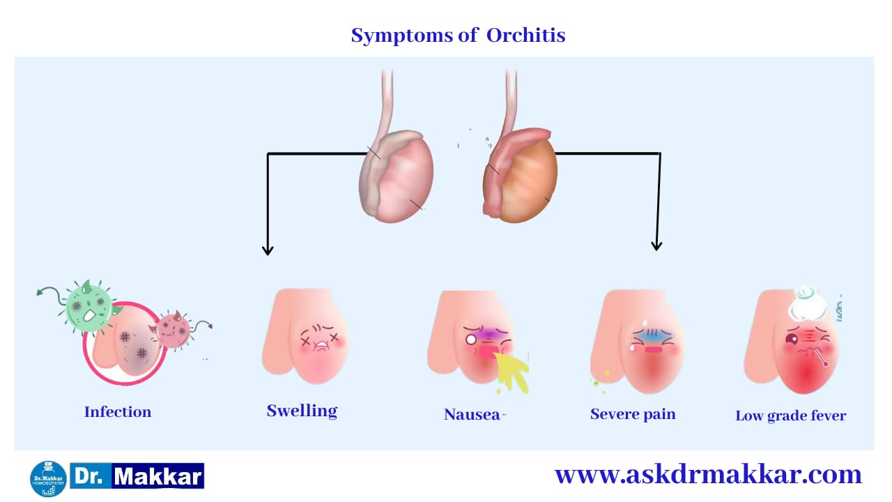 Symptoms of Orchitis || ऑर्काइटिस के लक्षण