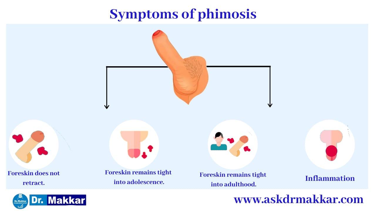 Symptoms of Phimosis || फाइमोसिस या निरुद्धप्रकाश शिश्न के लक्षण