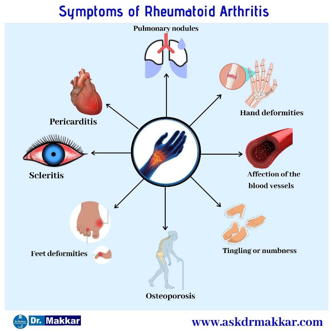 Symptoms of Rheumatoid arthritis ,scleritis,hand deformities ,feet deformities,Pericarditis,vasculitis,tingling,osteoporosis