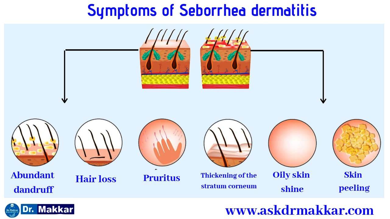 Symptoms of Seborrhic Dermatitis