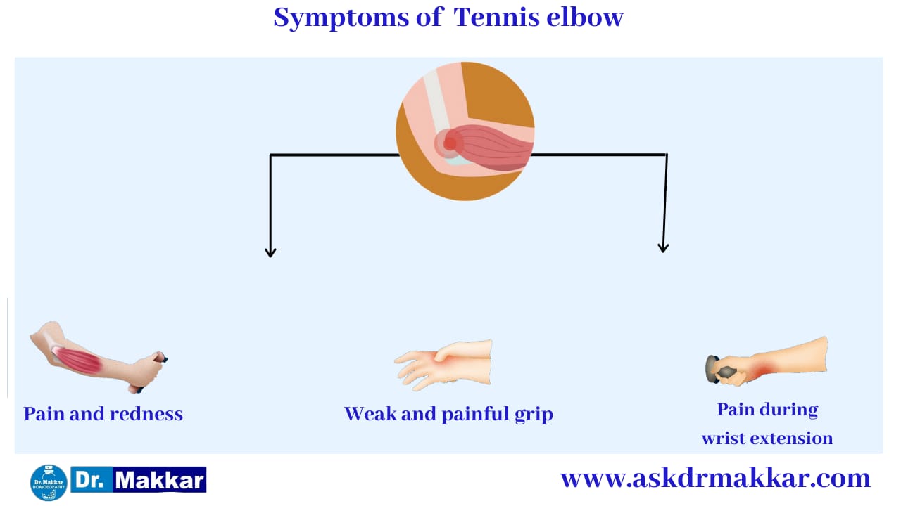 Symptoms of Tennis Elbow || टेनिस एल्बो के लक्षण के लक्षण