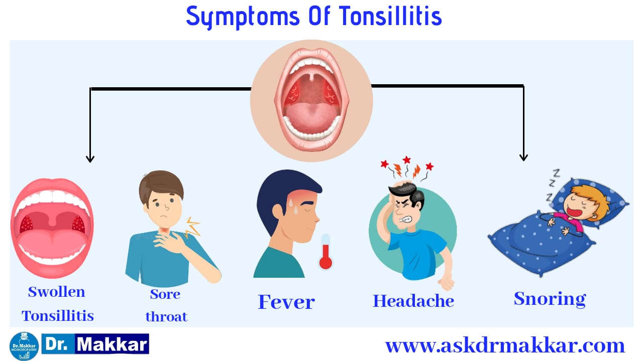 Symptoms of Tonsillitis