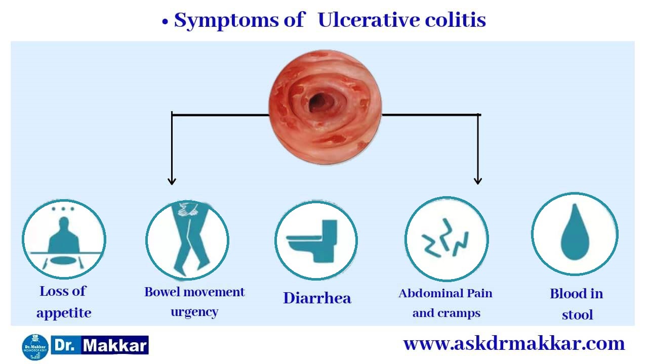 Symptoms of Ulcerative Colitis  || आंतों में सूजन इन्फेक्शन अल्सरेटिव कोलाइटिस के लक्षण