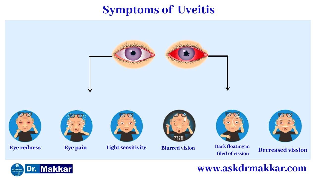 Symptoms of Uveitis eye disease || यूवाइटिस आंखों से संबंधित रोग के लक्षण