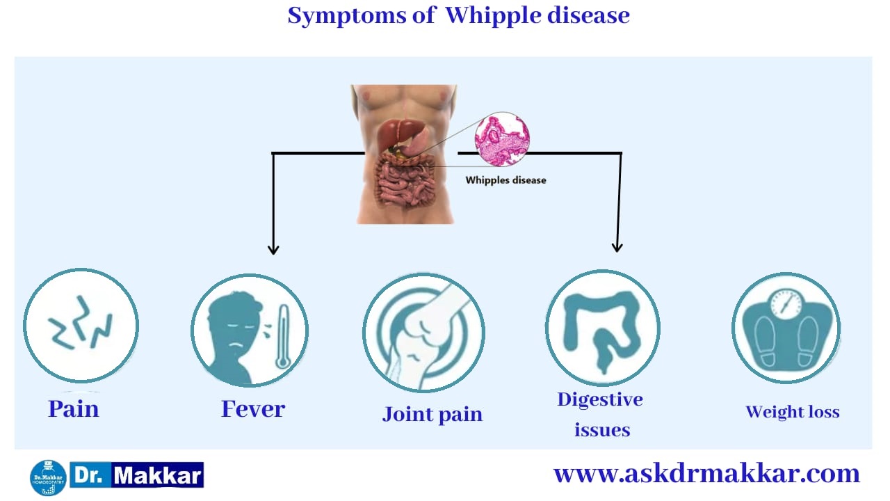 Symptoms of Whipple’s Disease || व्हिपल रोग के लक्षण
