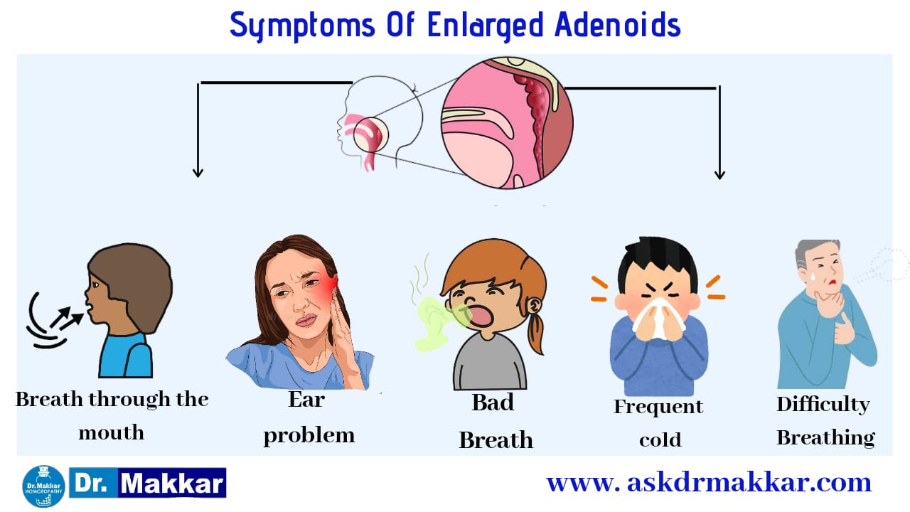 Symptoms of adenoid nasal polyp 