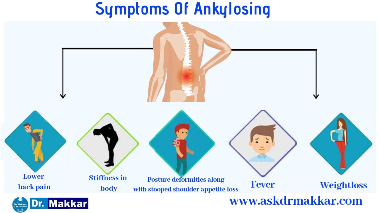 Symptoms of ankylosing Spondolysis