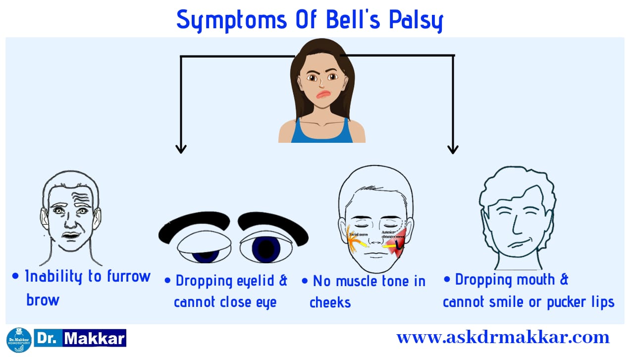 Symptoms of bells palsy