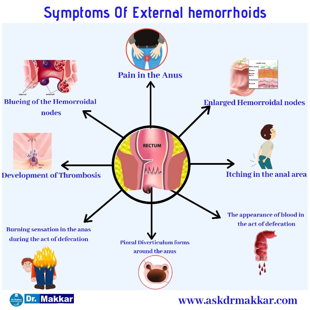 Symptoms of  Hemorrhoids also termed as piles || बवासीर के लक्षण जिसे पाइलस भी कहा जाता हैPiles Initial symptoms like anal itching swelling pain etc by homeopthic Dr Makkar