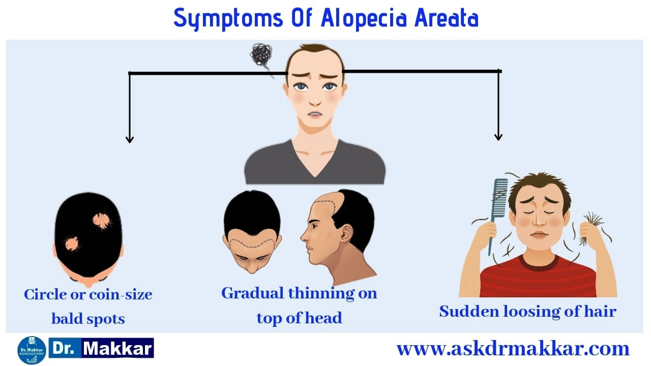 Symptoms of hair loss alopecia aerata