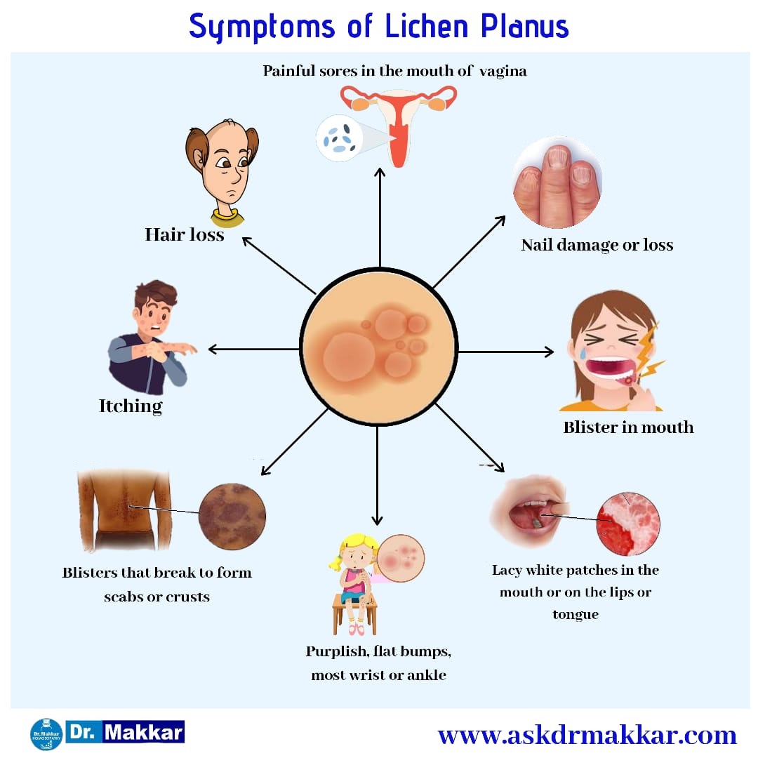 Symptoms of lichen planus