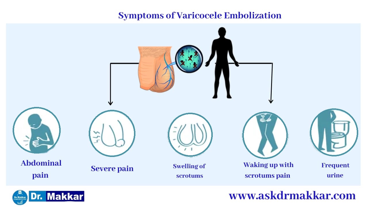 Symptoms of varicocele  वैरिकोसेले के लक्षण