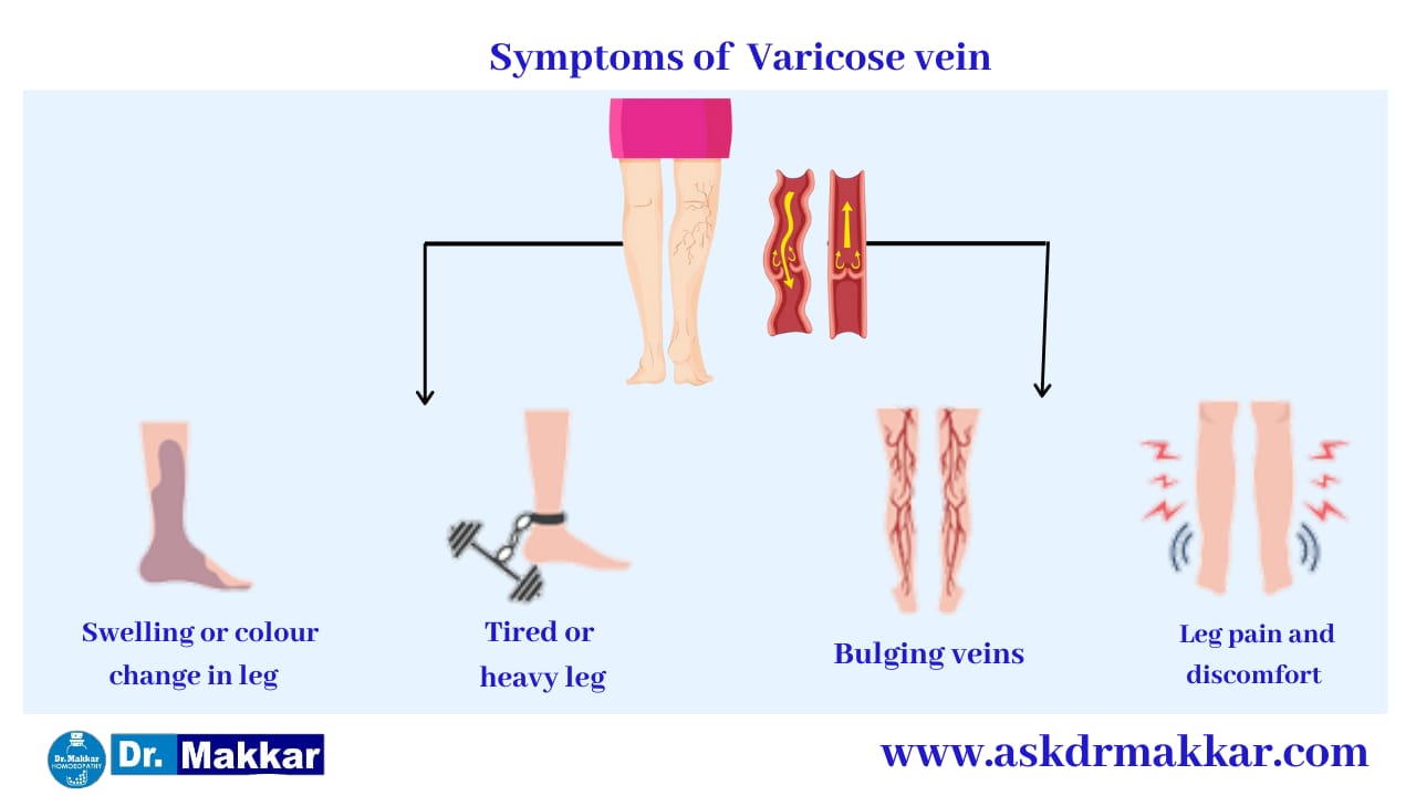 Symptoms of varicosity of veins   वैरिकोसिटी के  के लक्षण