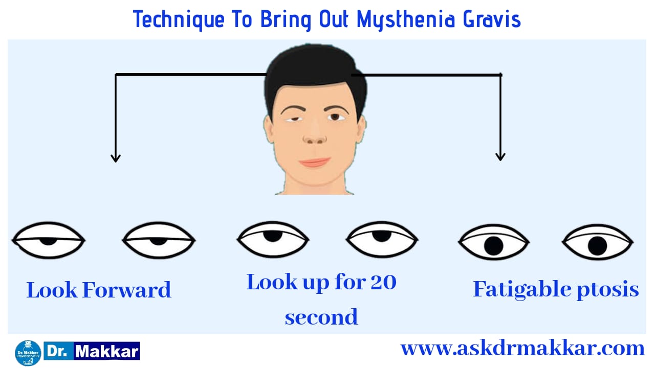 Technique to bring out Mysthenia Gravis