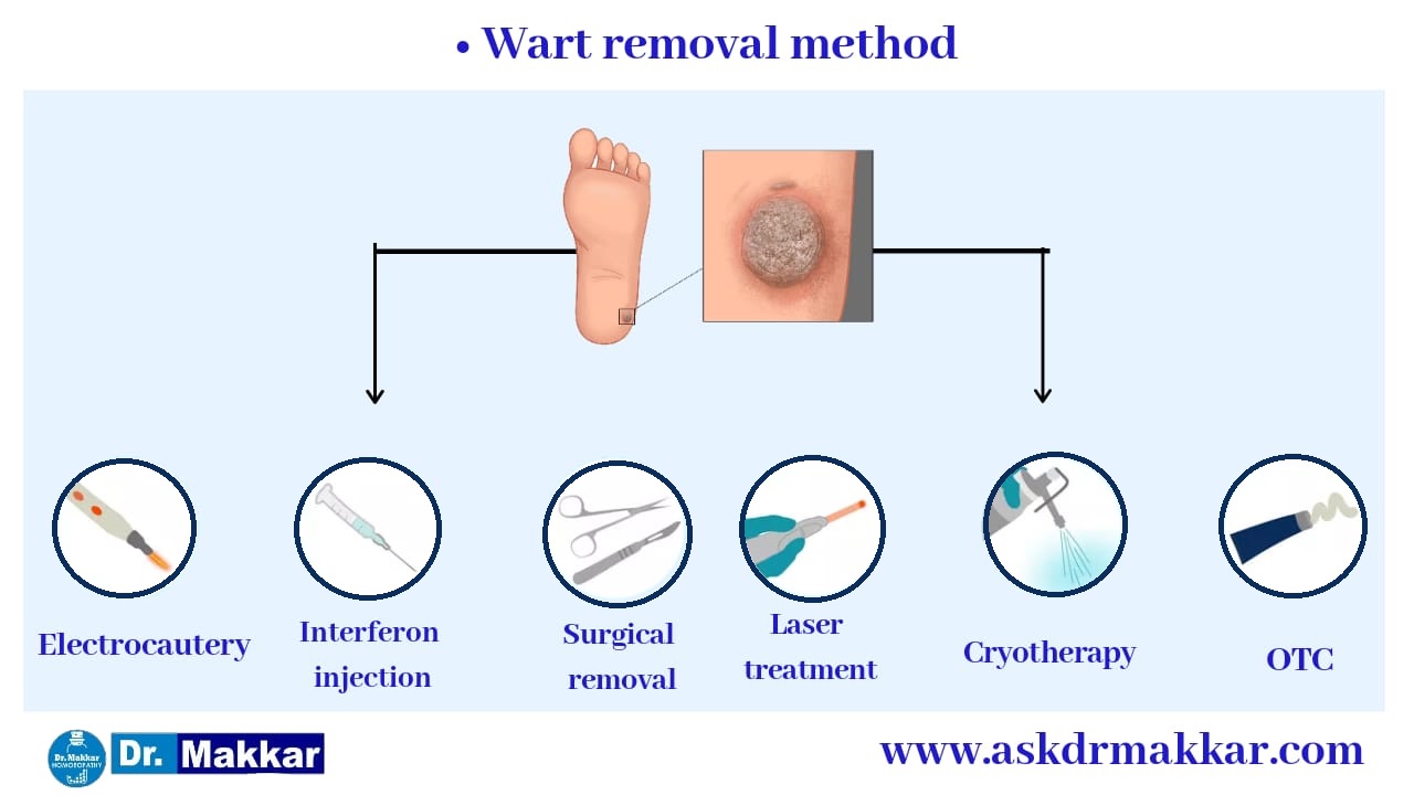 Temporary Methods used in Modern science to deal warts  