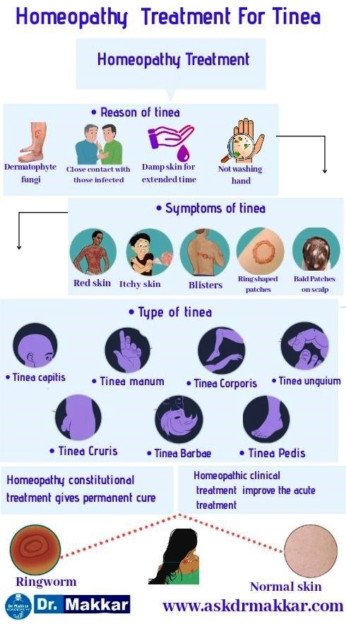 Tinea Ringworm homeopathic treatment.