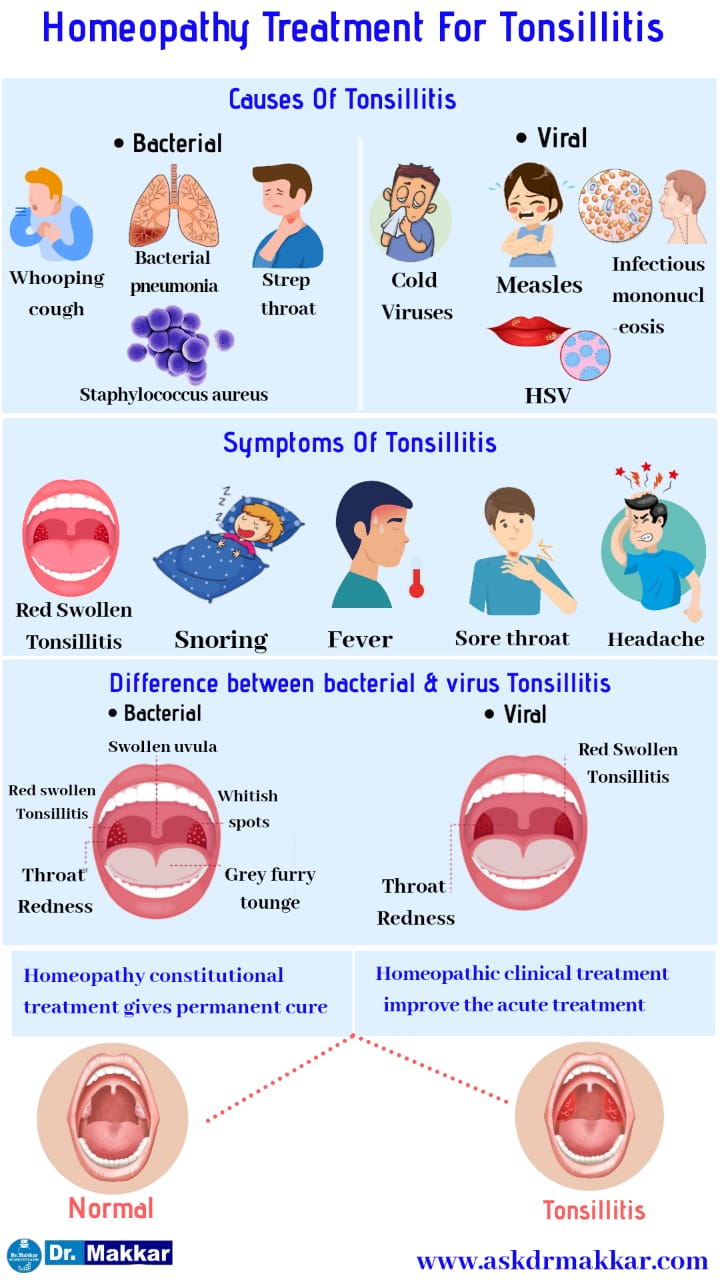 Tonsillitis homeopathic treatment without surgery