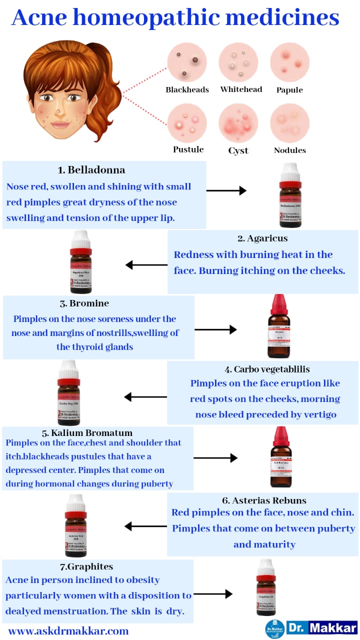 Best Homeopathic Medicine for Acne top remedies which cure acne permanently  || मुंहासों को ठीक करने वाले शीर्ष उपचार के लिए सर्वश्रेष्ठ होम्योपैथिक चिकित्सा होम्योपैथिक दवा