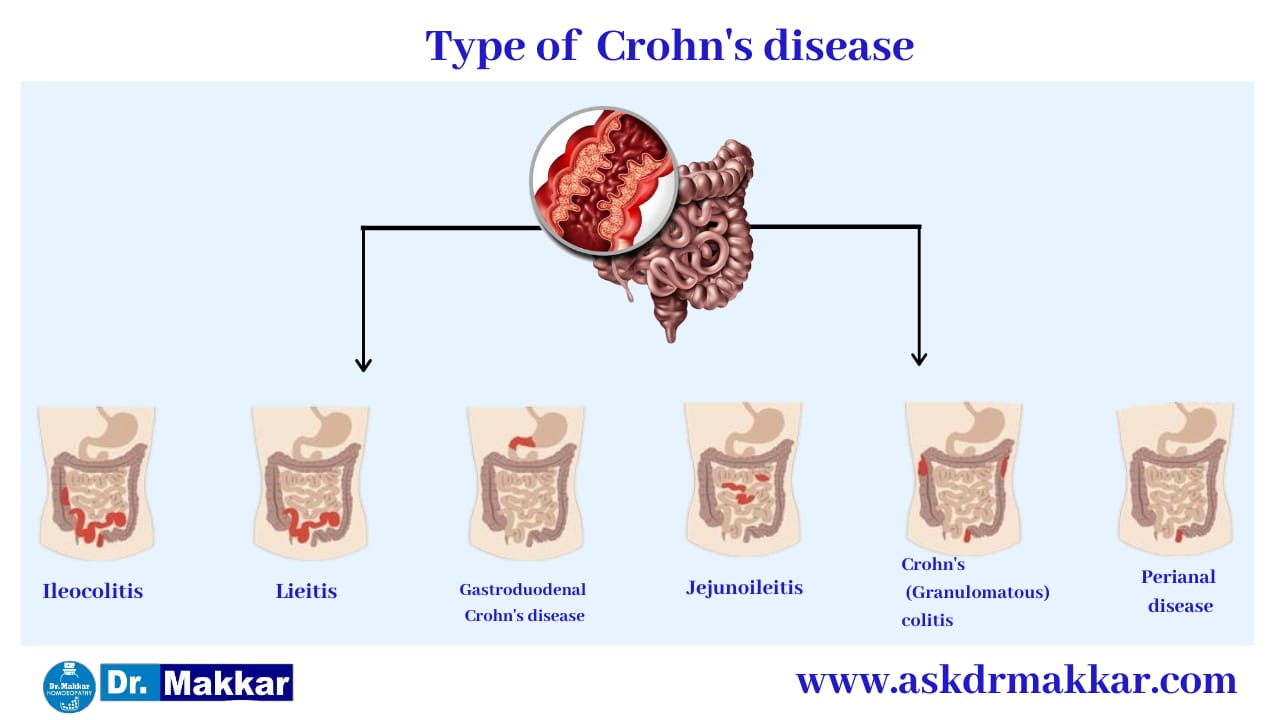 Type of Crohns Disease Inflammation of intestine || आंतों में सूजन  क्रोहन रोग का प्रकार