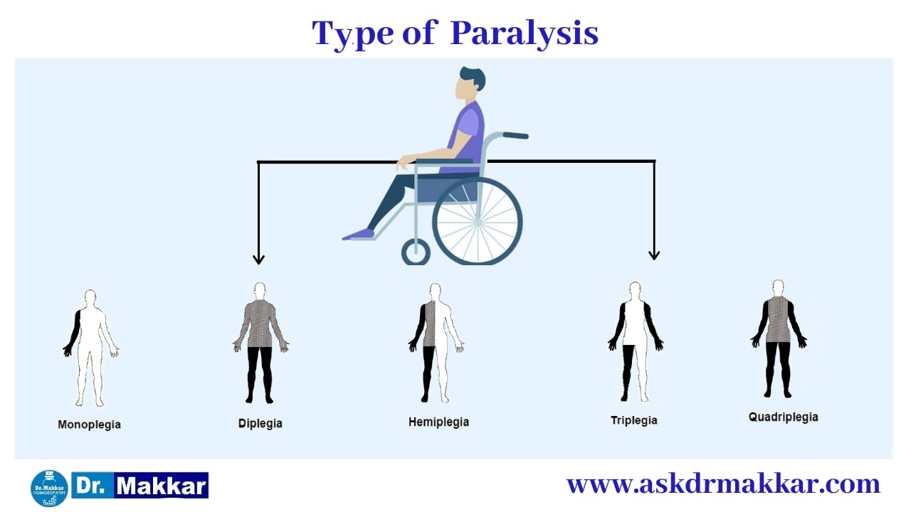 Types of Paralysis || लकवा मारना  पक्षाघात  कितने प्रकार का होता है? 