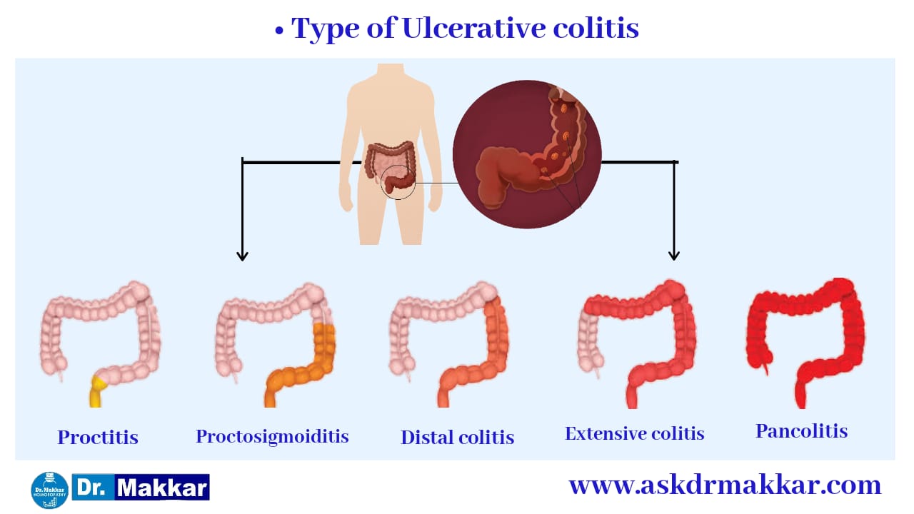  Type of Ulcerative colitis classification ?आंतों में सूजन अल् सरेटिव कोलाइटिस के प्रकार