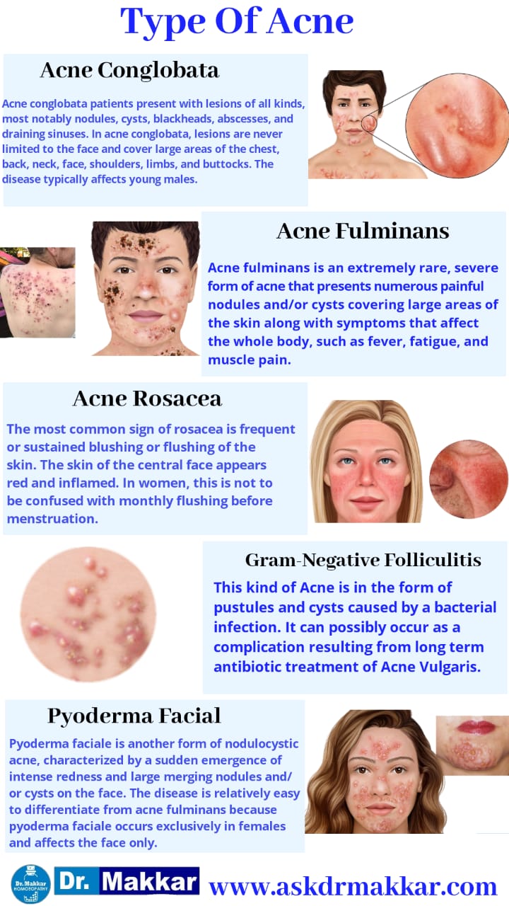 Types of acne