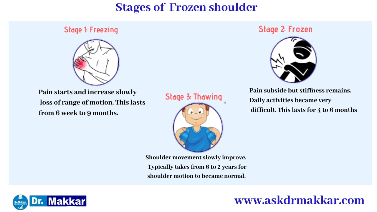 Types  Stages of Frozen Shoulder stiffness of shoulder || कंधे की अकड़न फ्रोज़न शोल्डर कितने चरणों प्रकार का होता है? 