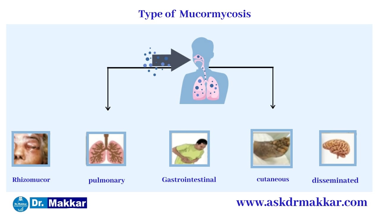 Types of  Mucormycosis || Black Fungus || Zygomycosis || ब्लैक फंगस कितने प्रकार का होता है? 