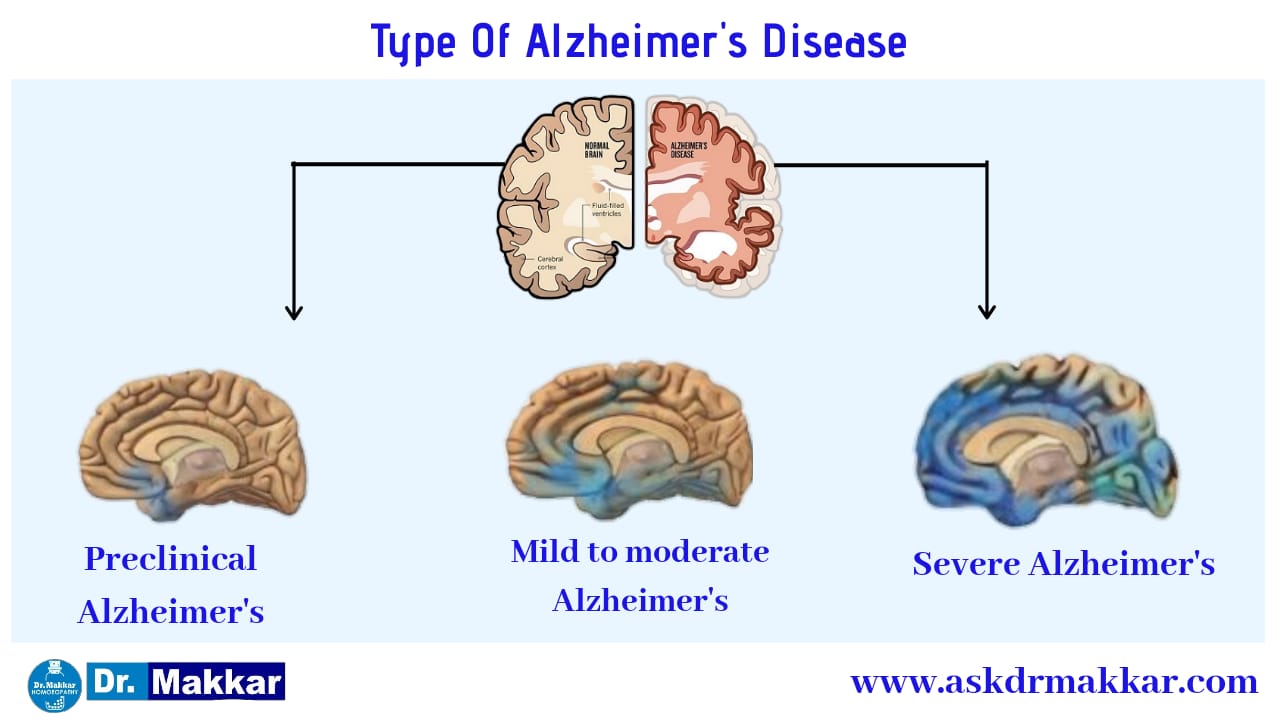 Types of Alzheimer's  disease