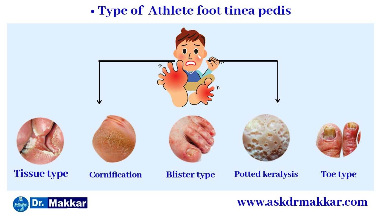 Types of Athlete foot Tinea Pedis  ||  एथलीट फुट टिनिया पेडिस प्रकार