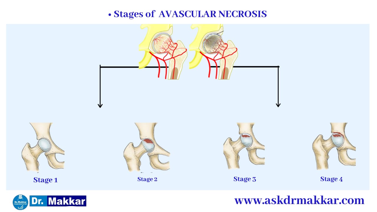 Types of Avascular Ischemic Necrosis AVN Osteonecrosis femur || एवस्कुलर इस्केमिक नेक्रोसिस एवीएन ओस्टियोनेक्रोसिस फीमर हड्डी के प्रकार