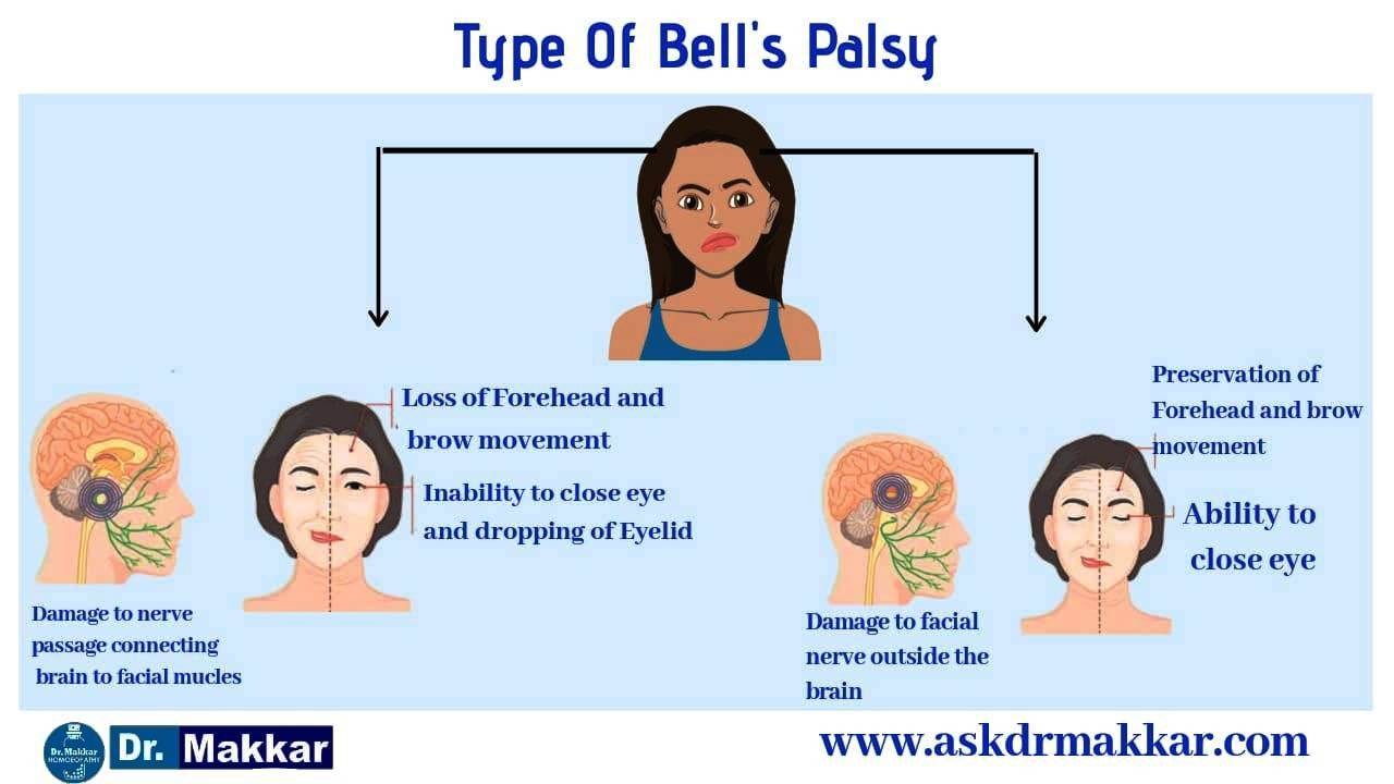 Types of Bells Palsy