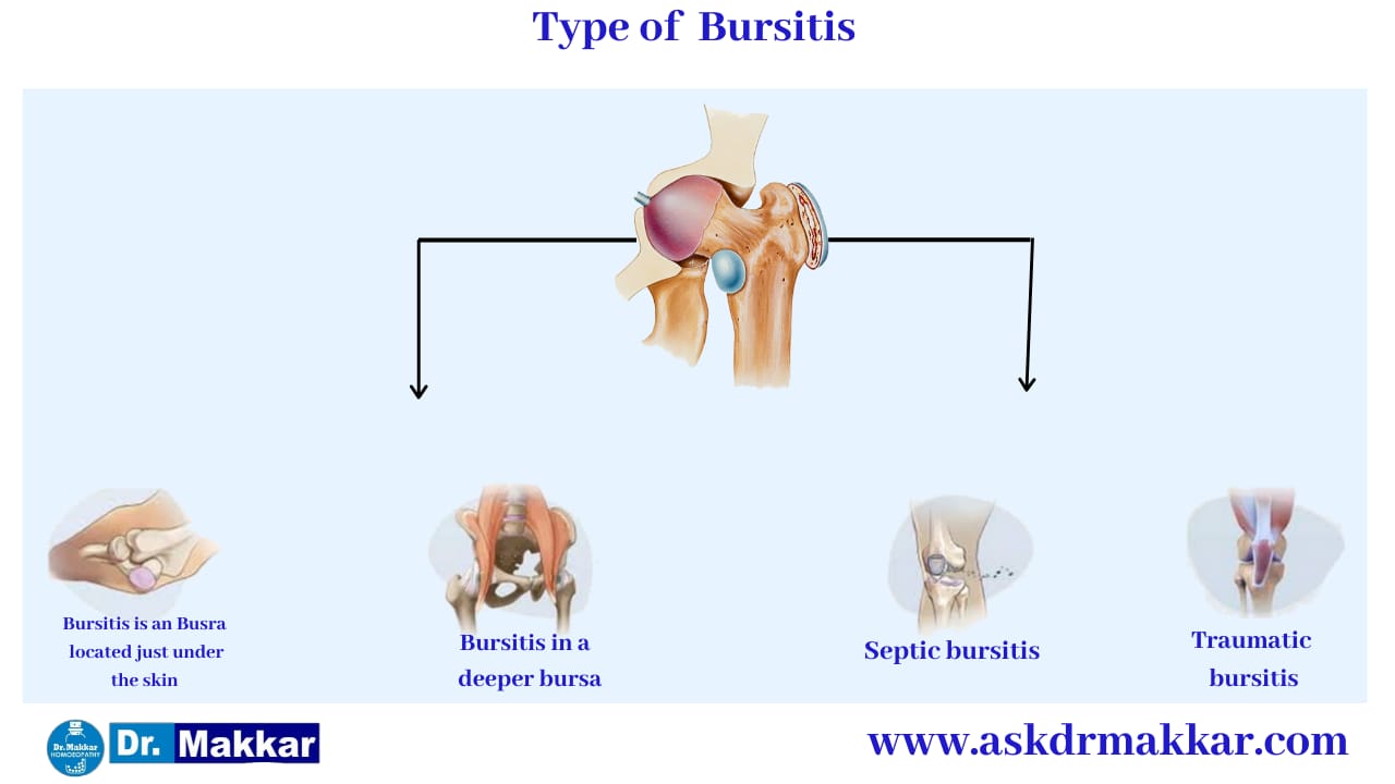 Types of Bursitis || बर्साइटिस कितने प्रकार का होता है? 