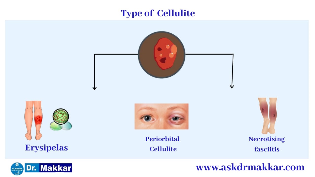 Types of Cellulitis Skin Infection || सेल्यूलाइटिस स्किन इंफेक्शन के प्रकार