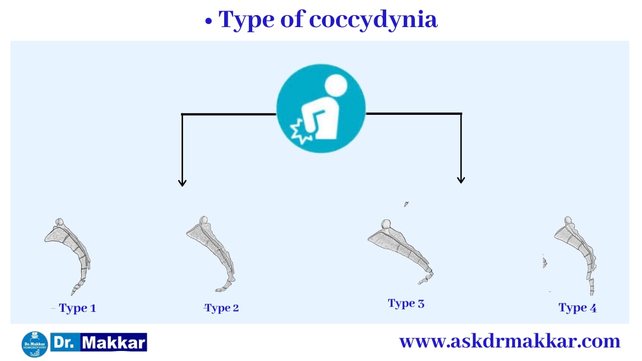 Types of Coccydynia due to Tailbone || कोक्सीडीनिया टेलबोन दर्द कितने प्रकार का होता है? 