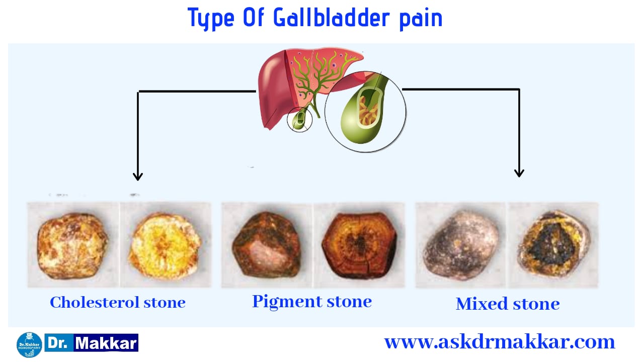 Types of Gallstone Cholelithiasis