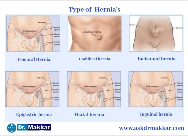 Types of Hernia according to body parts involved शरीर के अंगों के अनुसार हर्निया के प्रकार