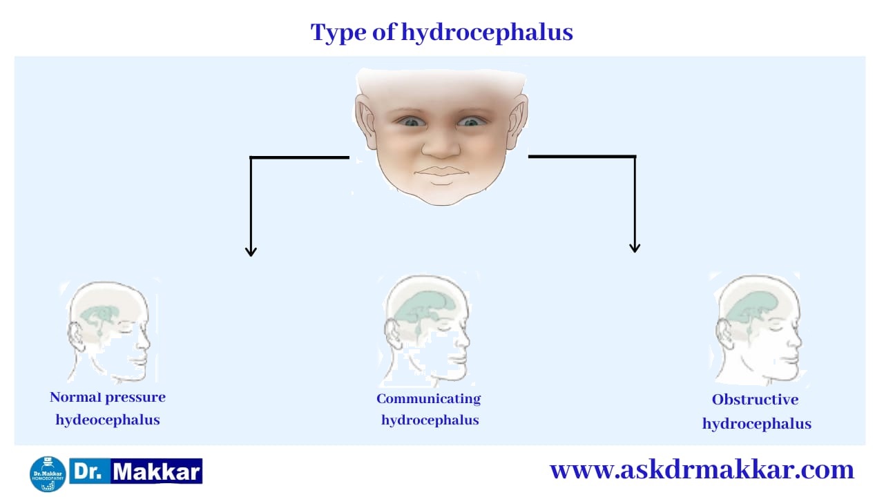 Types of Hydrocephalus || जलशीर्ष हाइड्रोसेफ़लस कितने प्रकार का होता है? 