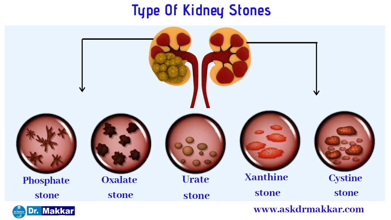 Types of Kidney stones Urolithiasis renal calculi, nephrolithiasis or urolithiasis