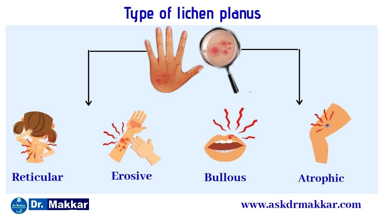 Type of Lichen Planus,Oral,reticular,erosive ,atrophic Type of Lichen Planus || लाइकेन प्लेनस का प्रकार