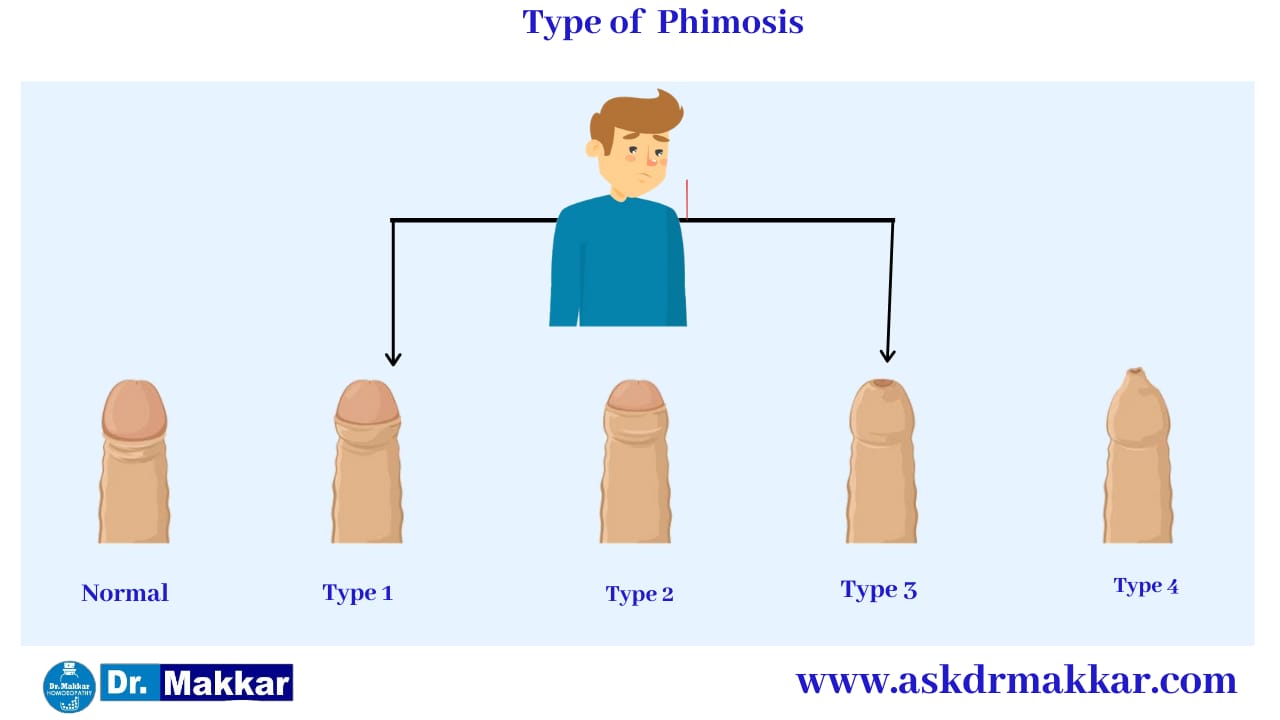 Types of Phimosis  फाइमोसिस या निरुद्धप्रकाश शिश्न के प्रकार