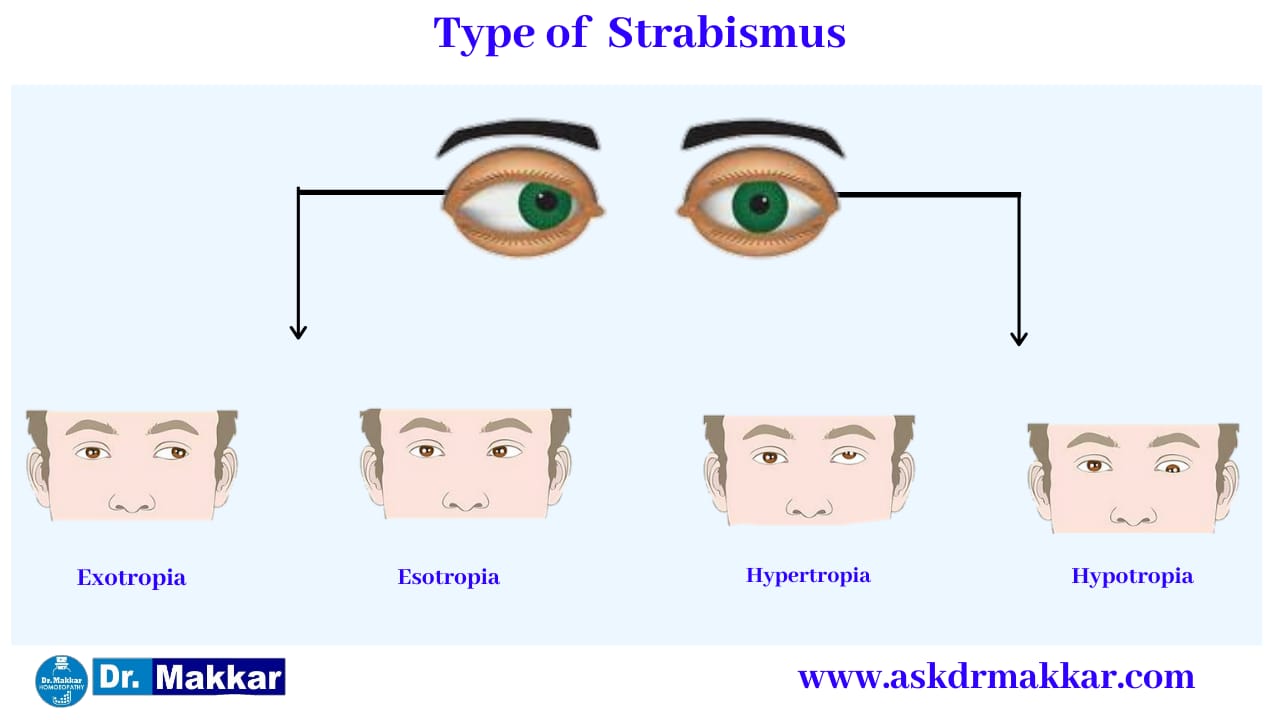 Types of Strabismus Crossed Eye || भेंगापन तिर्यकदृष्टि स्ट्राबिस्मस कितने प्रकार का होता है? 