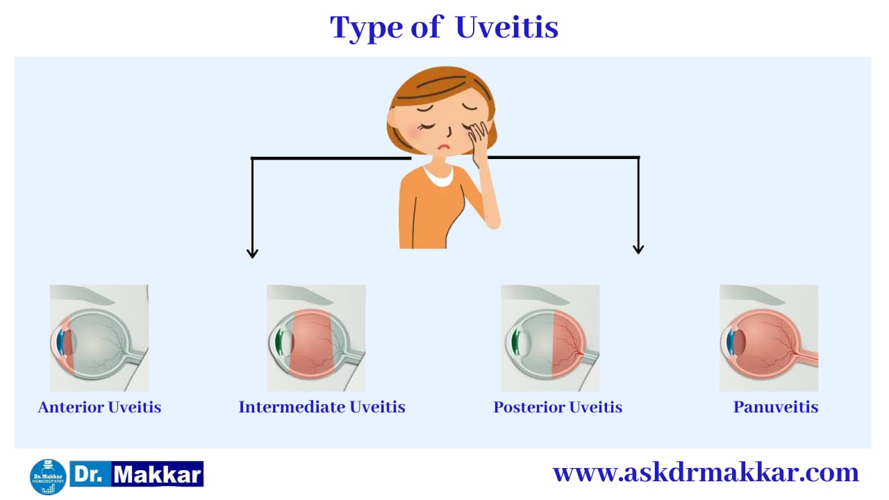 Types of Uveitis eye disease || यूवाइटिस आंखों से संबंधित कितने प्रकार का होता है? 