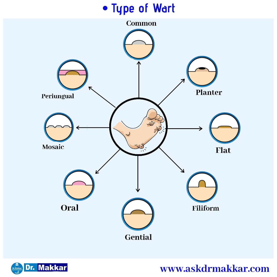  Types of Warts || कॉमन वार्ट्स मस्सों के प्रकार 