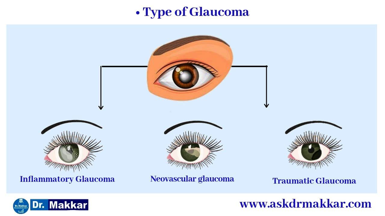 Types of glaucoma  ग्लूकोमा कितने प्रकार का होता है 