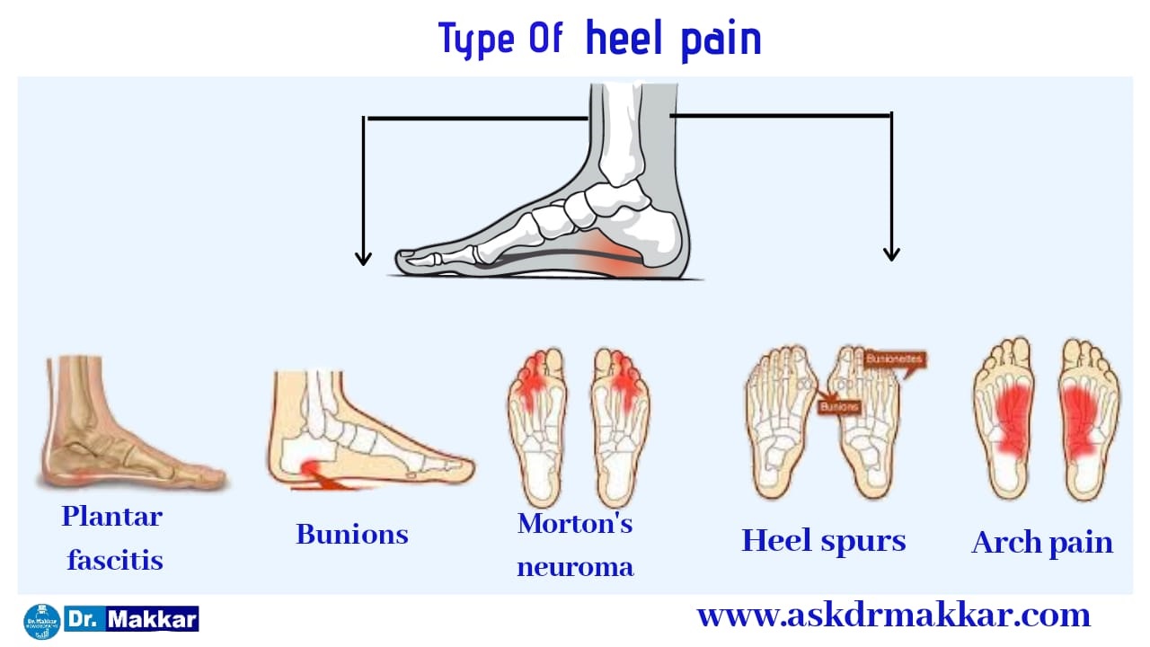	Types of heel pain causes Calcaneal Spur