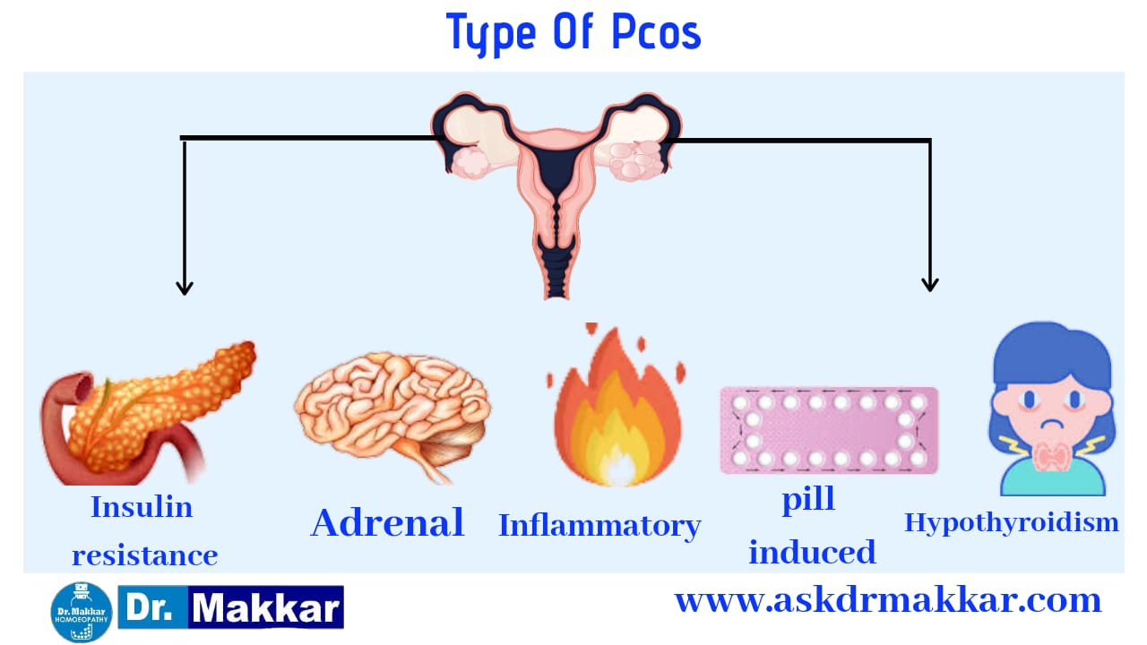 Types of Polycystovarian syndrome pcos
