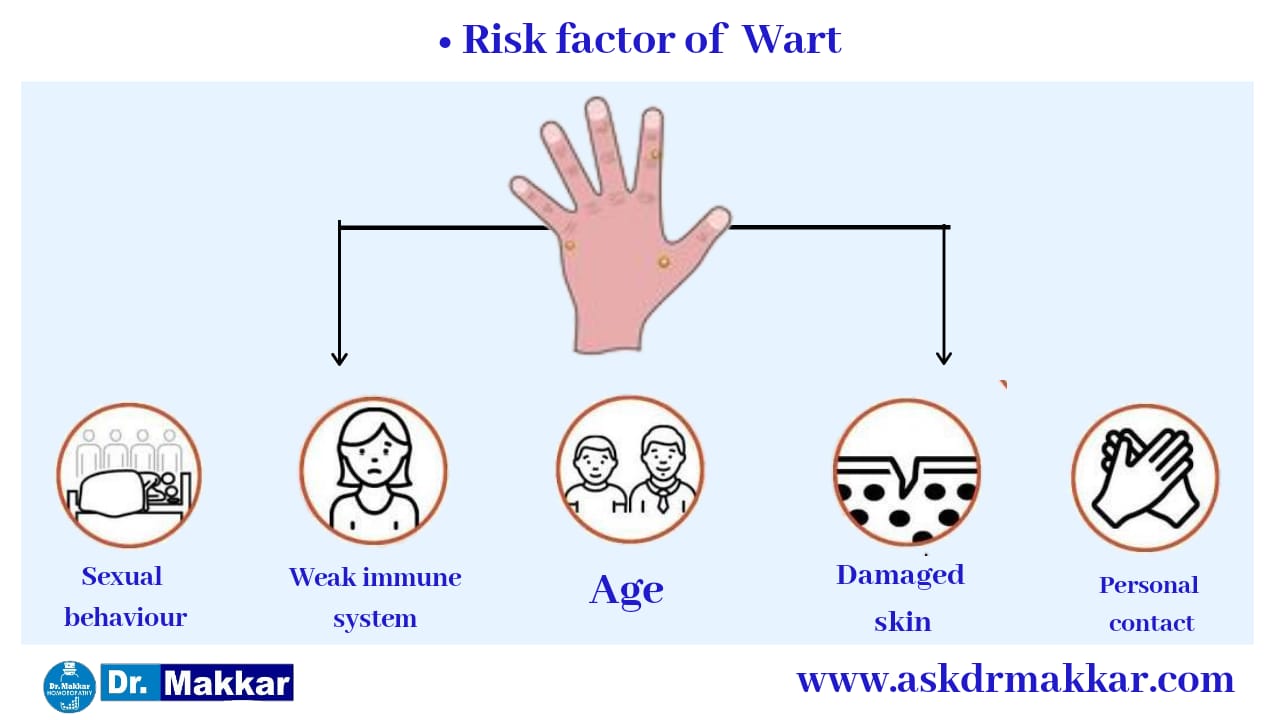 Who Gets Warts? Risk factors || कॉमन वार्ट्स मस्से का जोखिम कारक