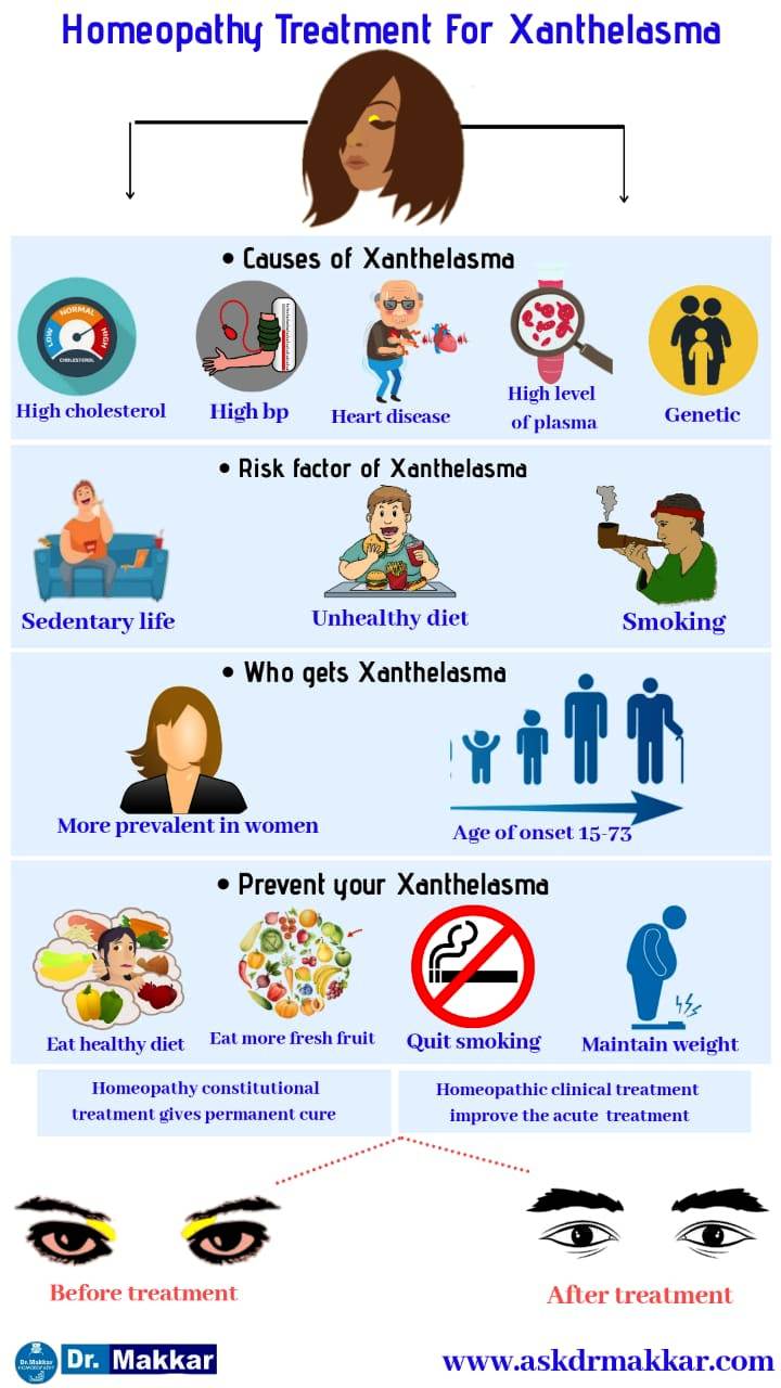 Xanthelasma homeopathic treatment